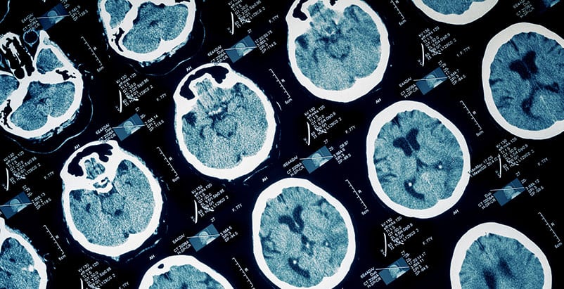 Nashville Traumatic Brain Injury Lawyers Nashville Traumatic Brain Injury Lawyers