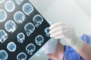Finding Hope for Veterans with TBI and PTSD Given an “Other-Than-Honorable” Discharge