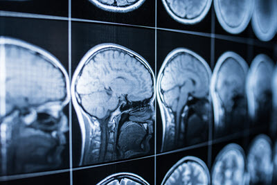 Brain Damage Medical Malpractice
