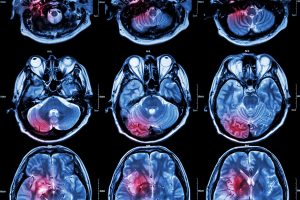 Common Causes of Work-Related Traumatic Brain Injuries