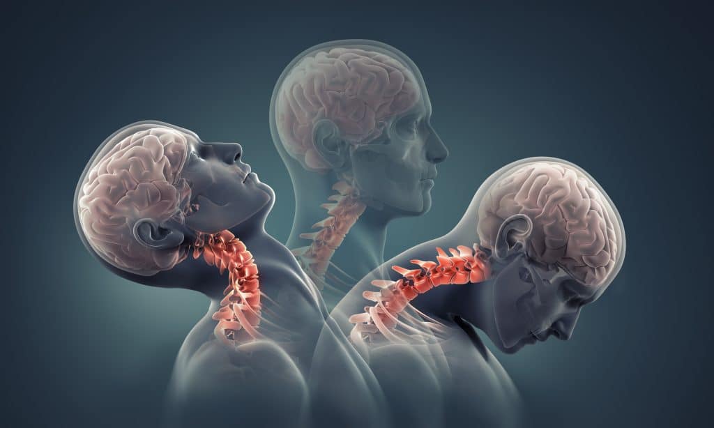 Your Neck in a Wreck: How Car Accidents Cause Long-Term Neck Trauma ...