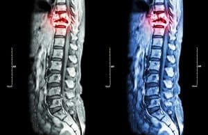 Lifetime Costs of a Spinal Cord Injury and Your Right to Compensation in Tennessee